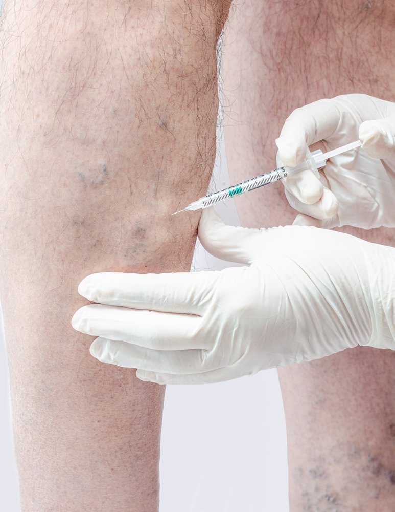 الحقن الرغوي للدوالي