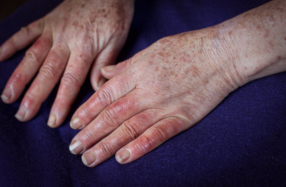 متلازمة رينود