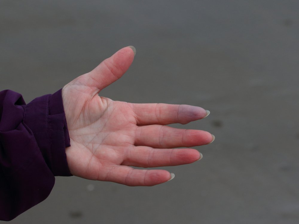 متلازمة رينود