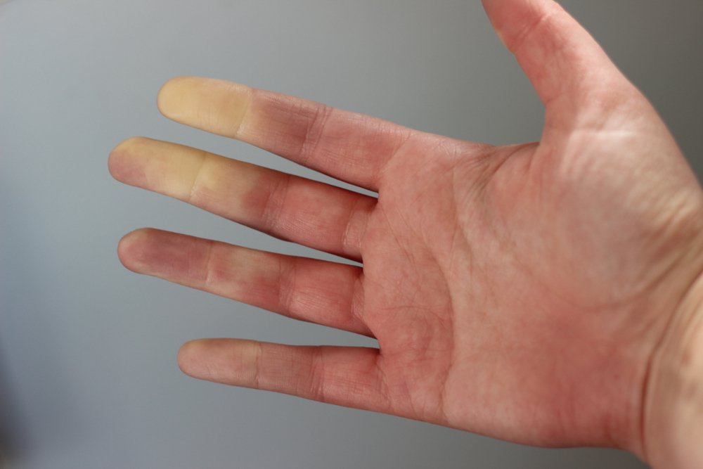 متلازمة رينود