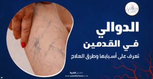الدوالي في القدمين
