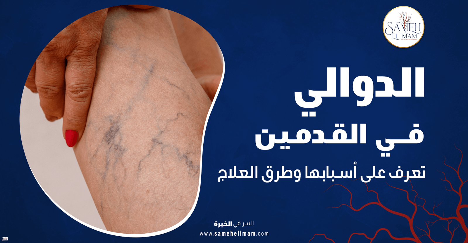 الدوالي في القدمين